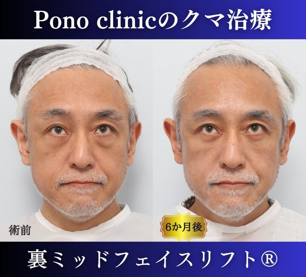 50代男性、目の下のクマ、 目の下のたるみ、裏ハムラ、ミッドフェイスリフト (6)