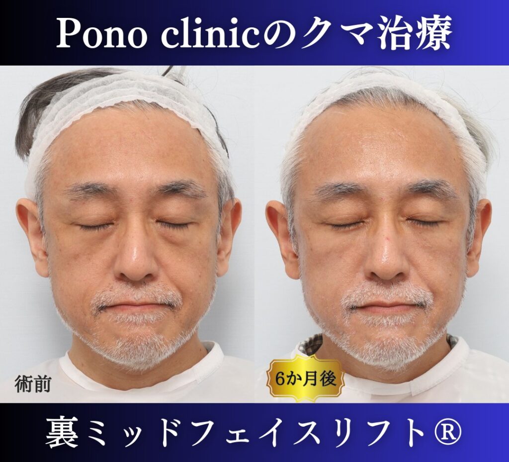 50代男性、目の下のクマ、 目の下のたるみ、裏ハムラ、ミッドフェイスリフト (7)