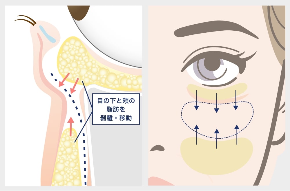 裏ミッドフェイスリフト®