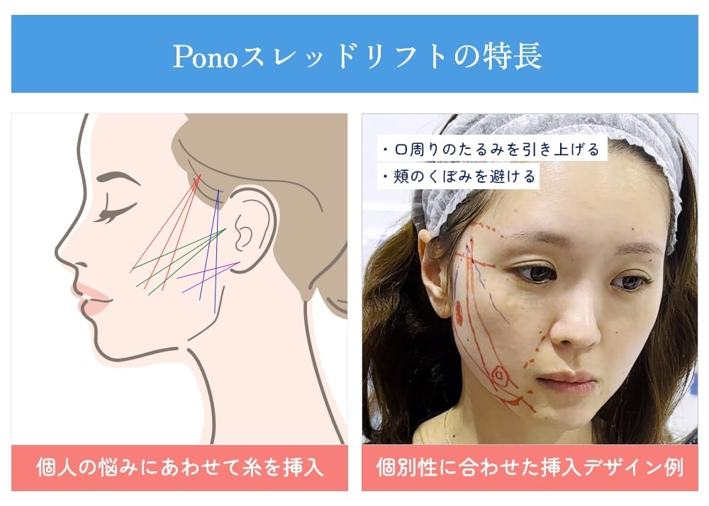 Ponoスレッドリフト
