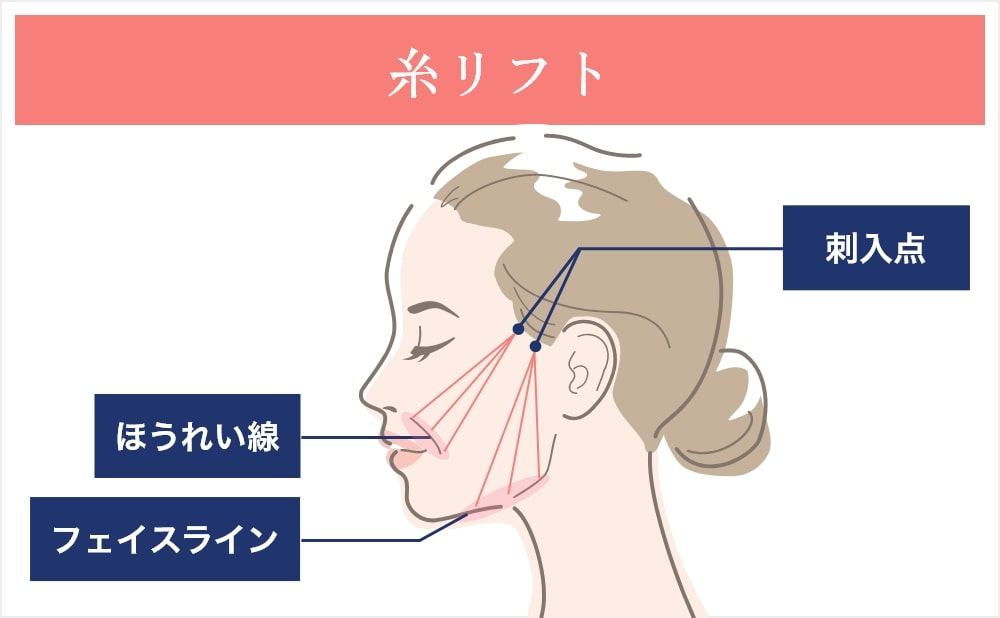 糸リフトの種類と特徴