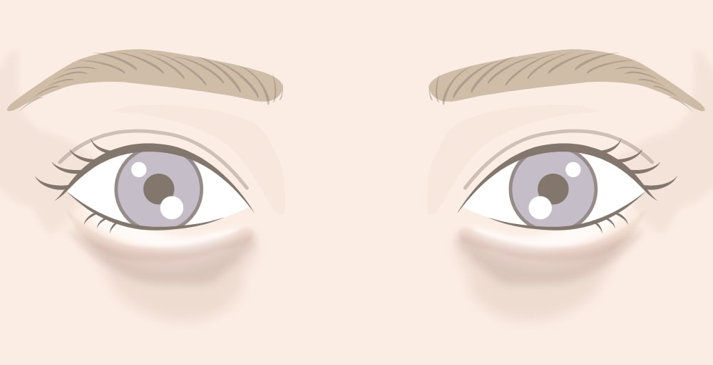 脱脂（クマ取り）をした後にくぼむ原因