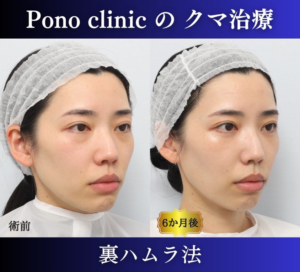 30代女性の症例、目の下のクマ取り、裏ハムラ、目の下のクマ改善 (2)