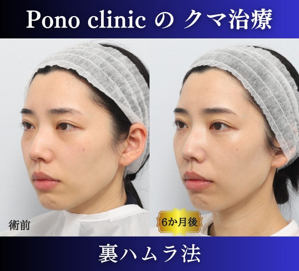 30代女性の症例、目の下のクマ取り、裏ハムラ、目の下のクマ改善 (3)