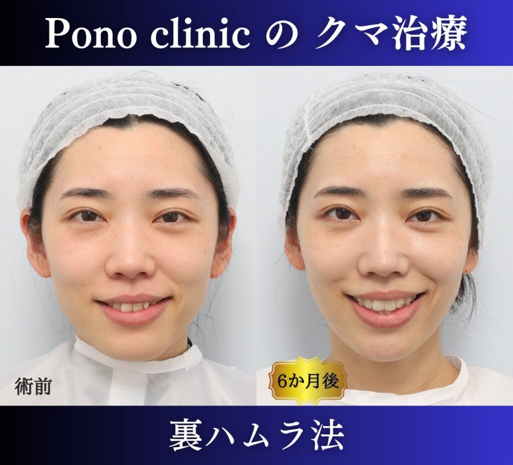 30代女性の症例、目の下のクマ取り、裏ハムラ、目の下のクマ改善 (4)