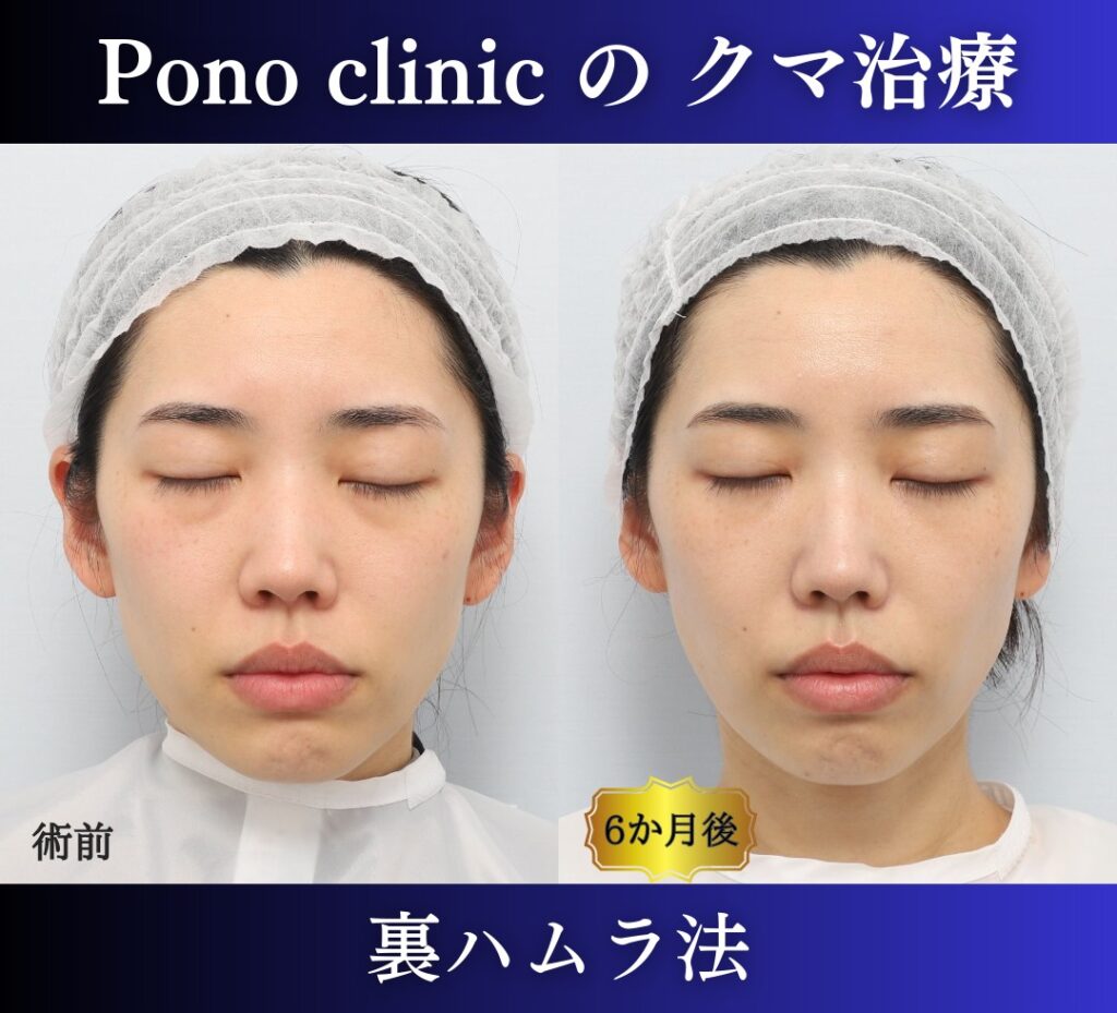 30代女性の症例、目の下のクマ取り、裏ハムラ、目の下のクマ改善 (6)