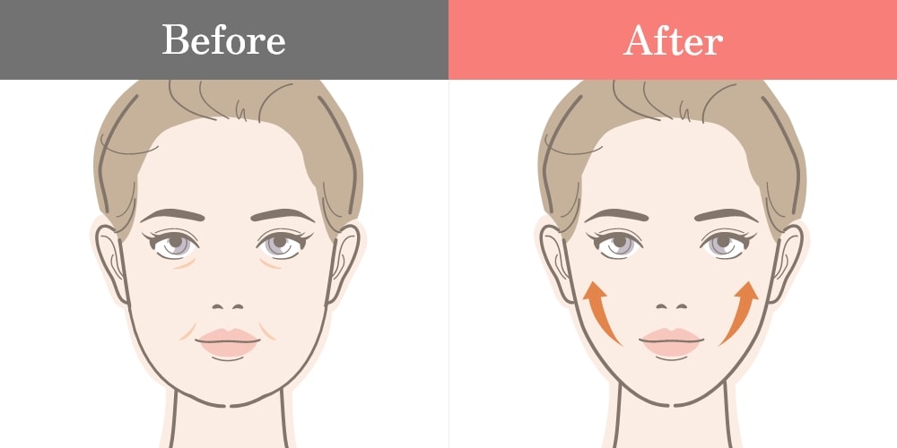 糸リフトの効果