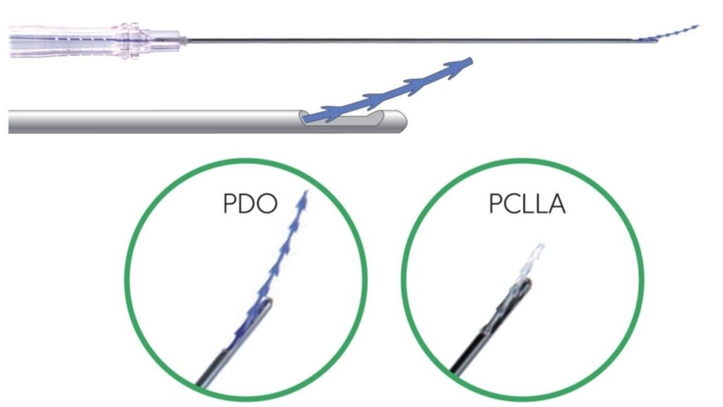 PDO(ポリジオキサノン)