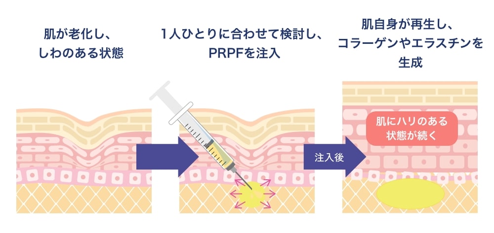 PRPF®療法