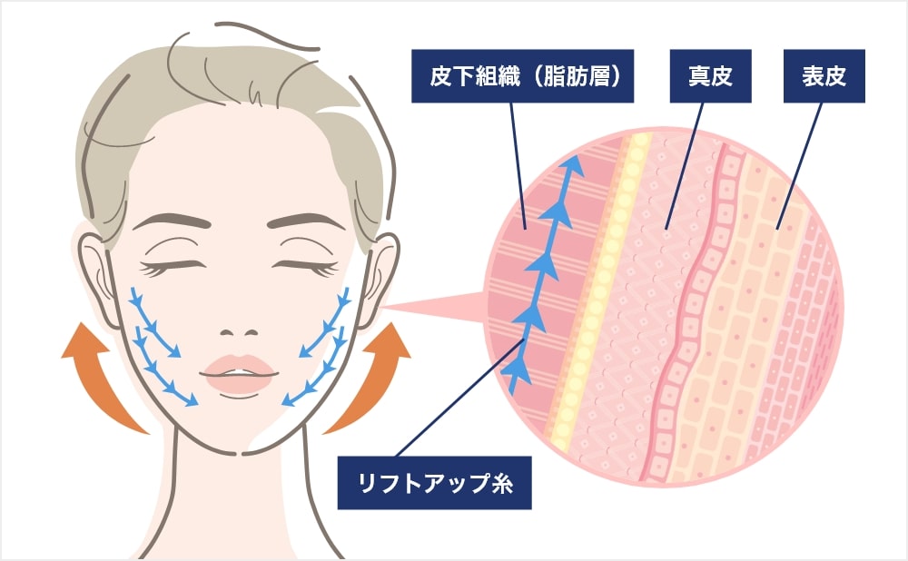 糸リフトとダウンタイムの基本