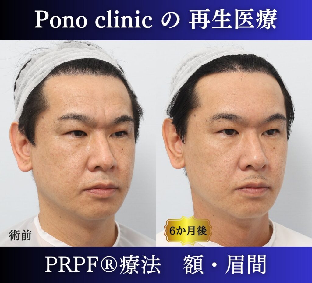 しわ取り、しわ治療、眉間のしわ、額のしわ、40代男性の症例 (1)