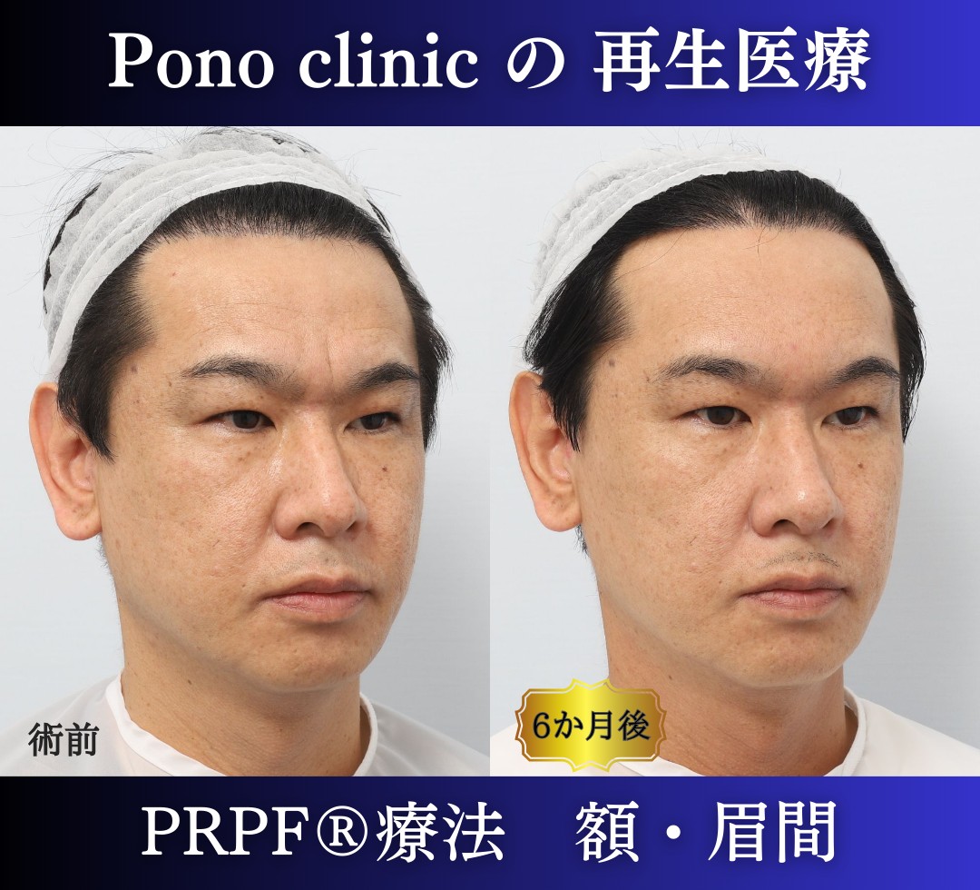 しわ取り、しわ治療、眉間のしわ、額のしわ、40代男性の症例 (1)