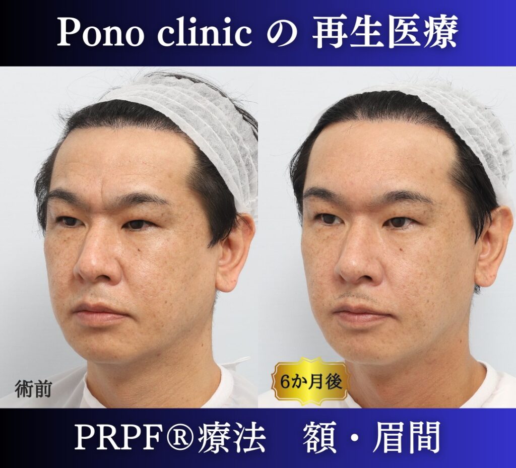 しわ取り、しわ治療、眉間のしわ、額のしわ、40代男性の症例 (2)