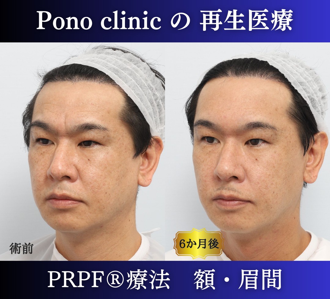 しわ取り、しわ治療、眉間のしわ、額のしわ、40代男性の症例 (2)