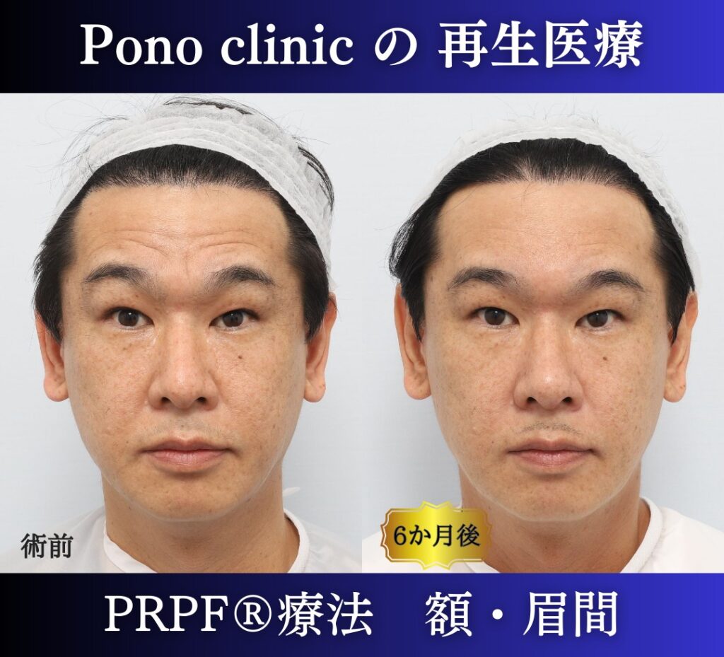 しわ取り、しわ治療、眉間のしわ、額のしわ、40代男性の症例 (3)