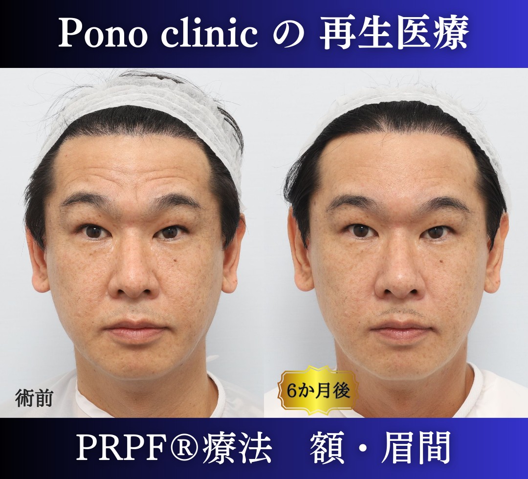 しわ取り、しわ治療、眉間のしわ、額のしわ、40代男性の症例 (3)