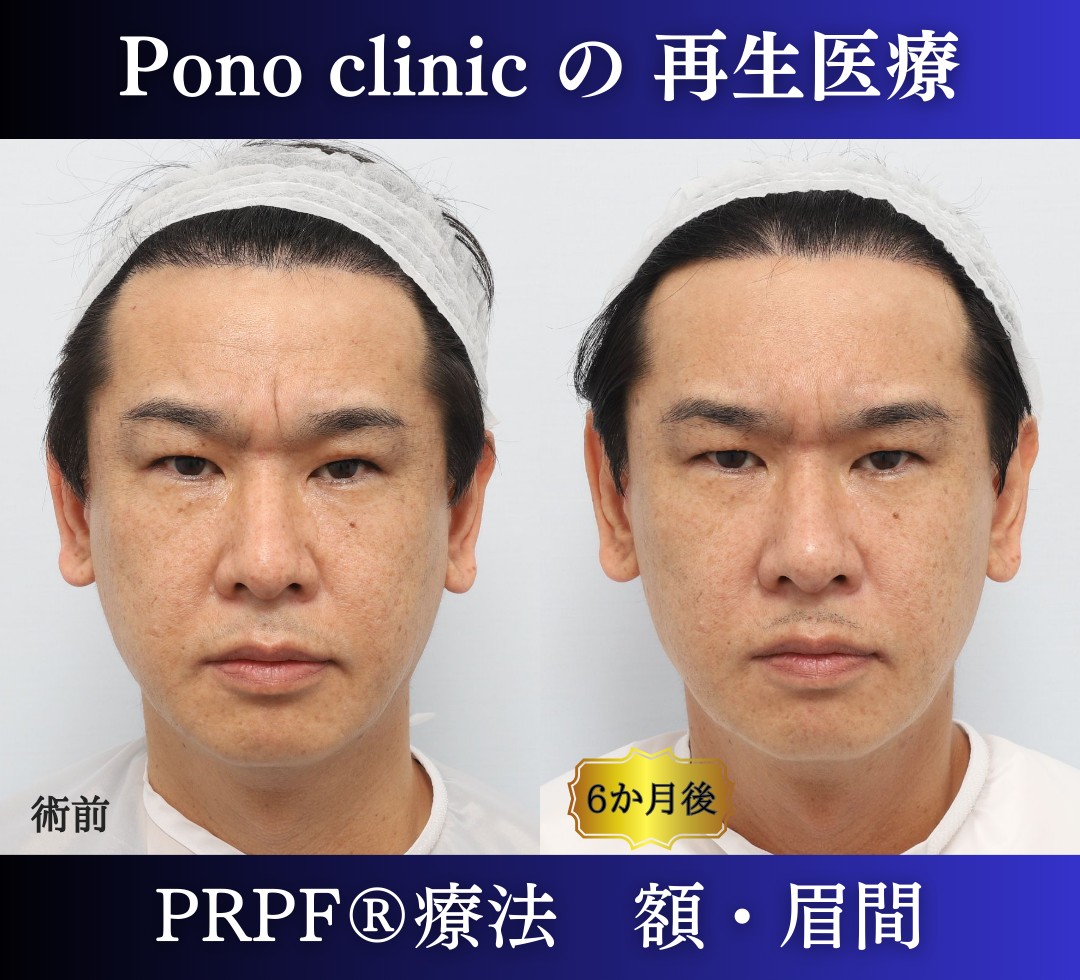 しわ取り、しわ治療、眉間のしわ、額のしわ、40代男性の症例 (4)