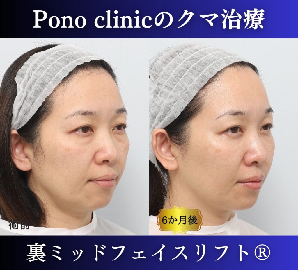 40代女性、目の下のクマ、裏ハムラ法、クマ取り 新宿、裏ミッドフェイスリフト (2)