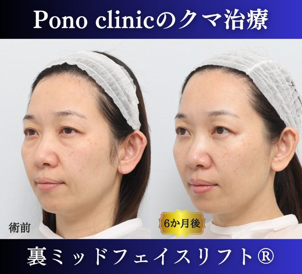 40代女性、目の下のクマ、裏ハムラ法、クマ取り 新宿、裏ミッドフェイスリフト (3)