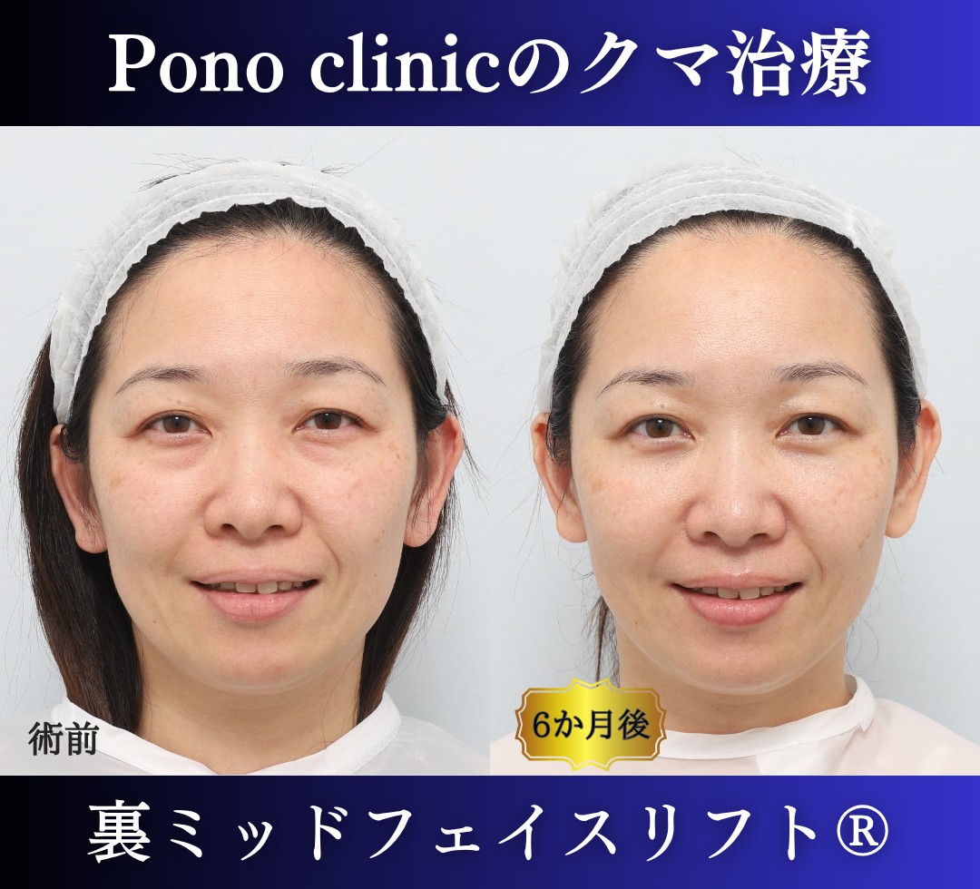 40代女性、目の下のクマ、裏ハムラ法、クマ取り 新宿、裏ミッドフェイスリフト (4)