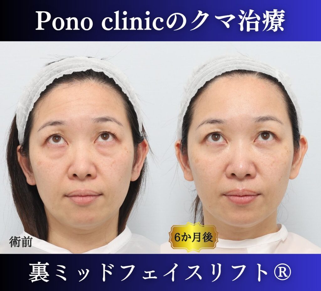 40代女性、目の下のクマ、裏ハムラ法、クマ取り 新宿、裏ミッドフェイスリフト (5)