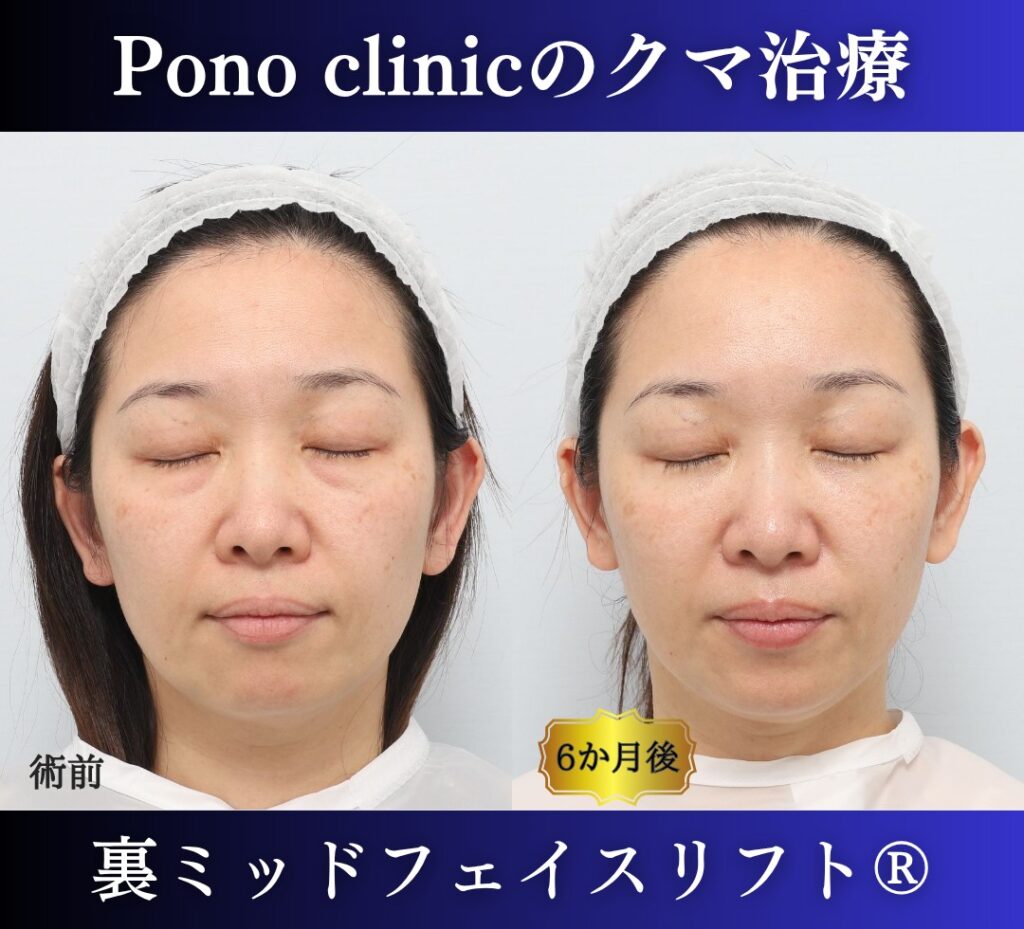 40代女性、目の下のクマ、裏ハムラ法、クマ取り 新宿、裏ミッドフェイスリフト (6)