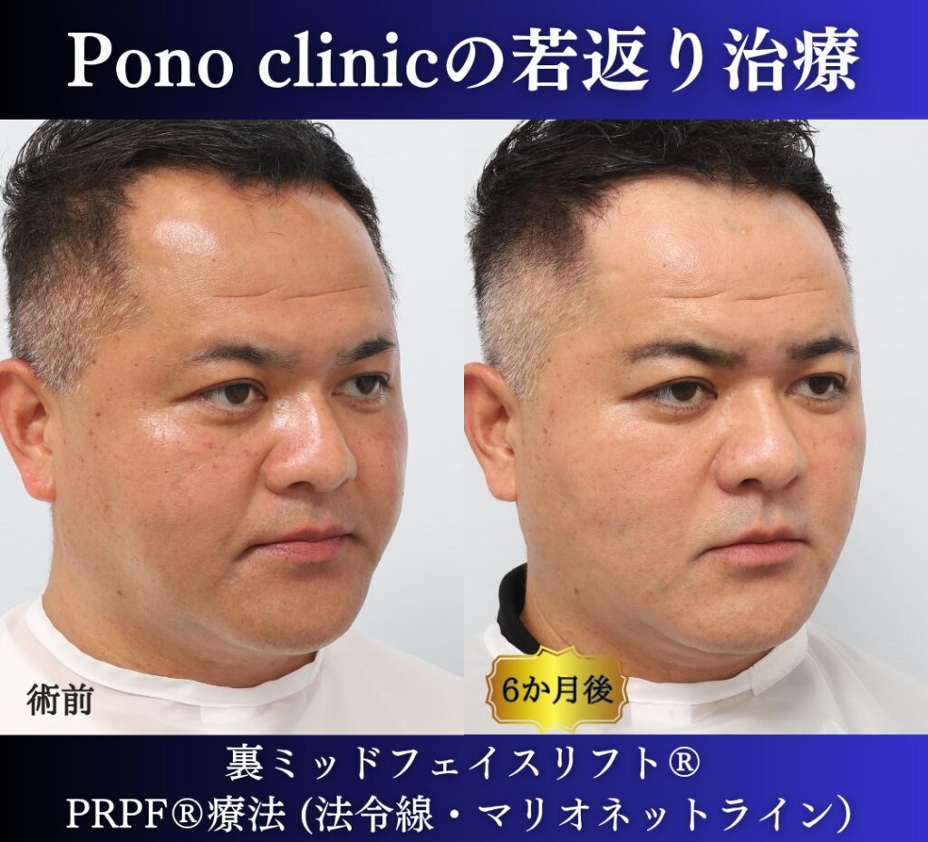 40代男性、クマ取り、しわ取り、法令線治療、裏ハムラ、裏ミッドフェイスリフト、PRP (2)