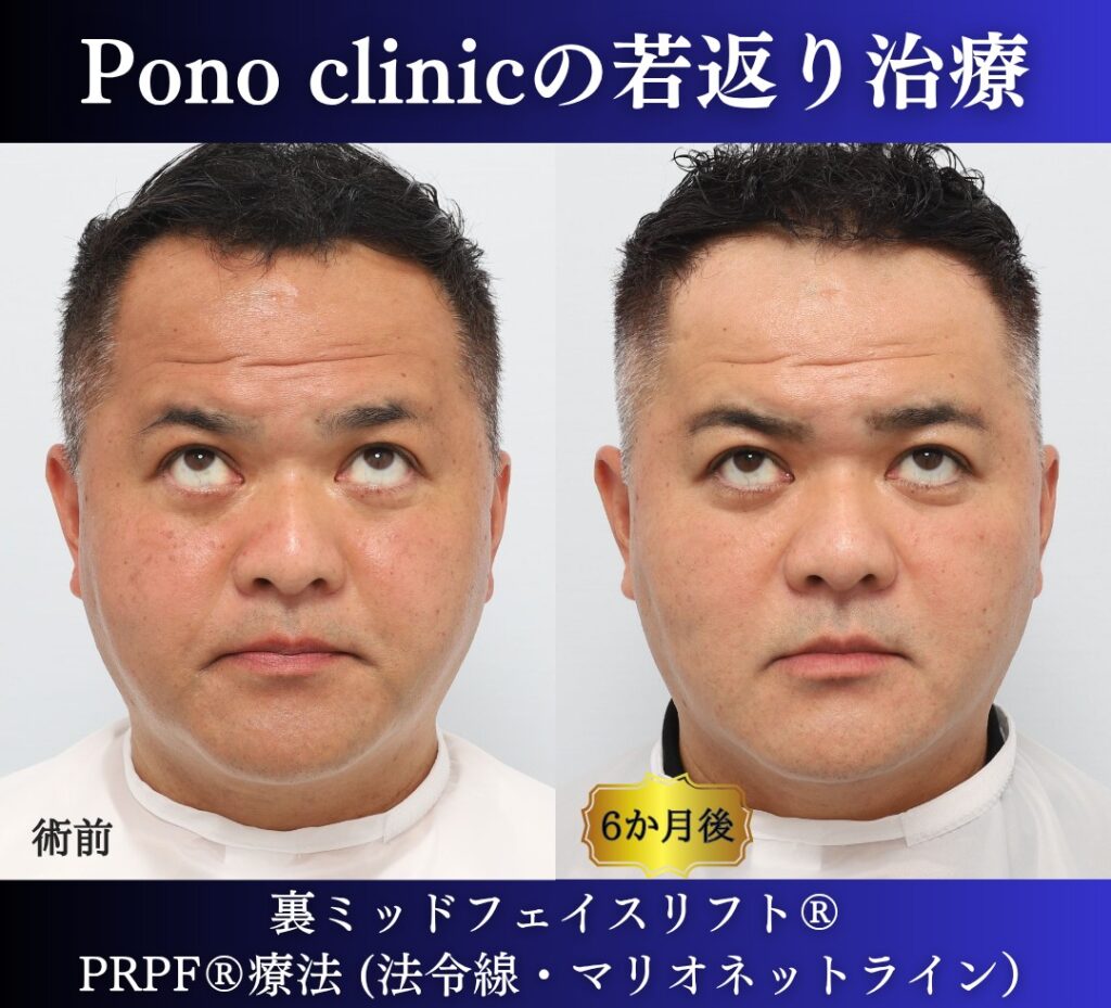 40代男性、クマ取り、しわ取り、法令線治療、裏ハムラ、裏ミッドフェイスリフト、PRP (5)