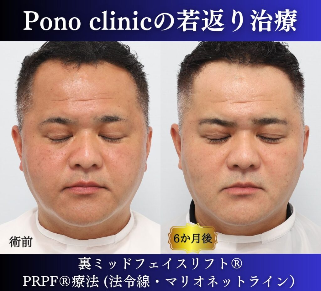 40代男性、クマ取り、しわ取り、法令線治療、裏ハムラ、裏ミッドフェイスリフト、PRP (6)