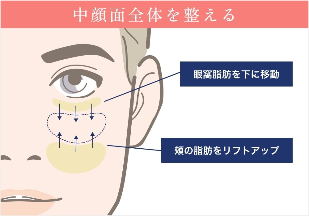 裏ミッドフェイスリフト®