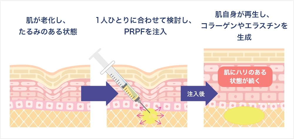 PRPF®療法