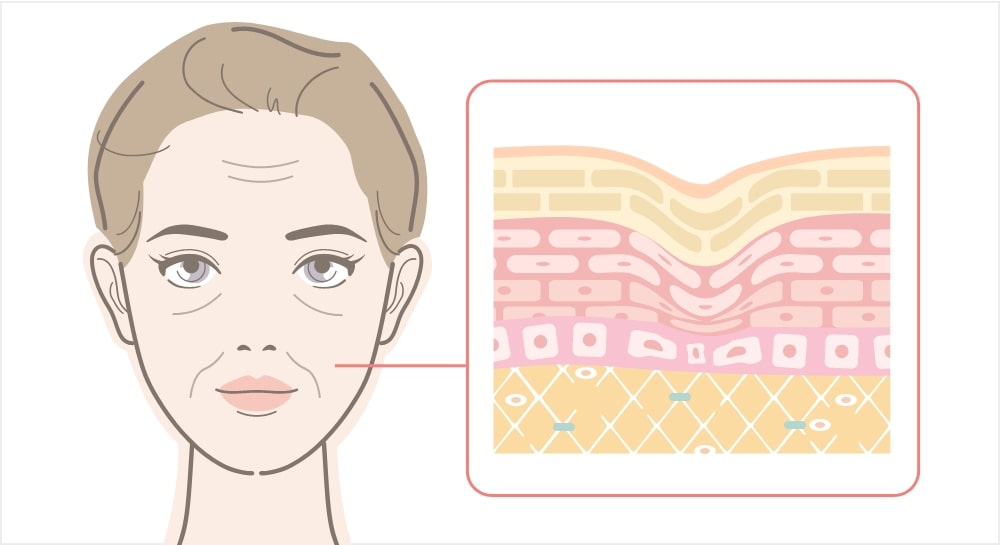 50代で顔のたるみが起こる原因