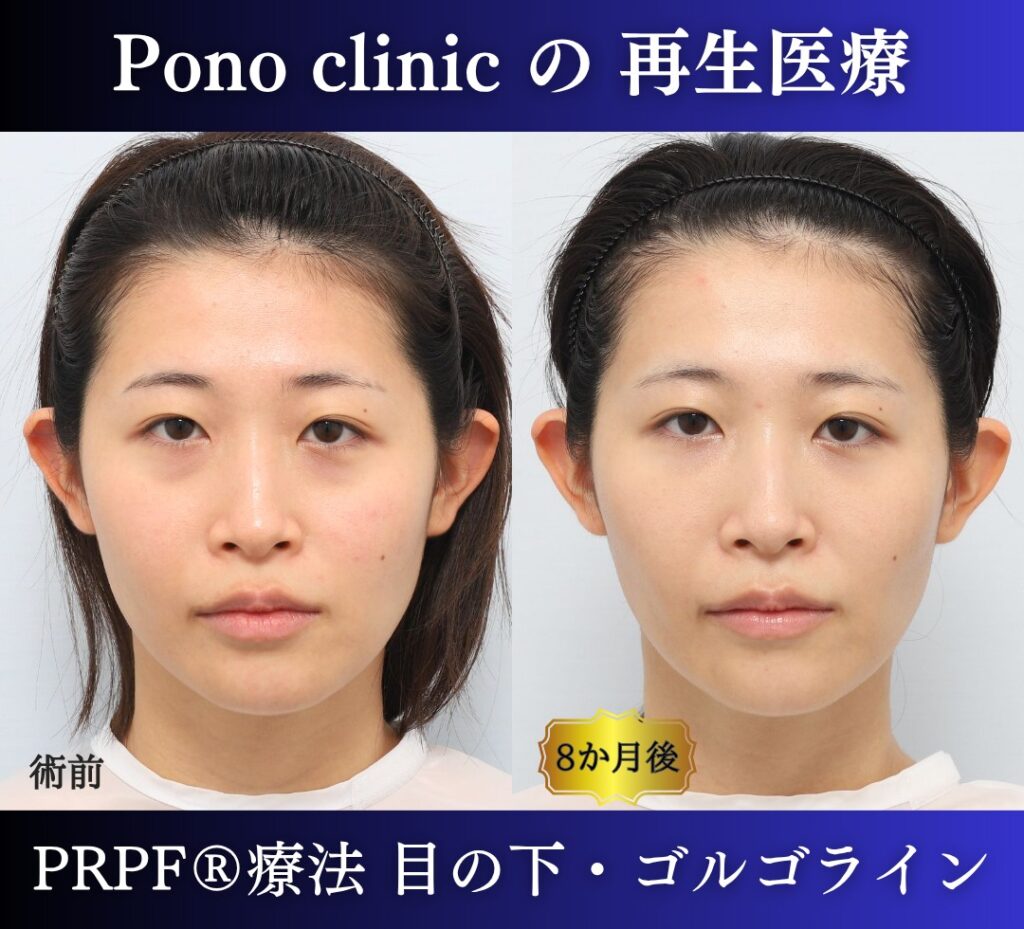 目の下のクマ、ゴルゴライン、クマ取り注射、PRPF療法 (1)