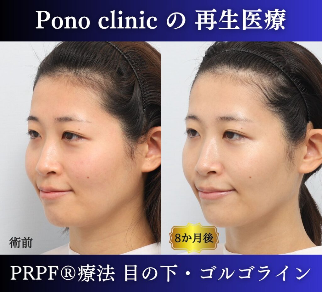 目の下のクマ、ゴルゴライン、クマ取り注射、PRPF療法 (10)