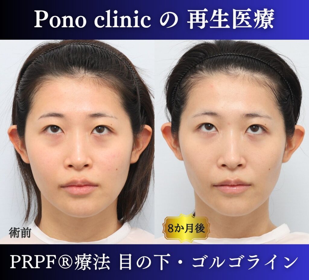 目の下のクマ、ゴルゴライン、クマ取り注射、PRPF療法 (11)