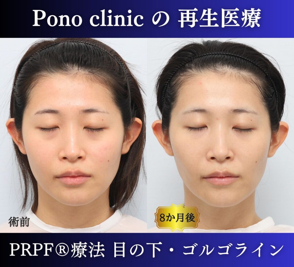 目の下のクマ、ゴルゴライン、クマ取り注射、PRPF療法 (12)