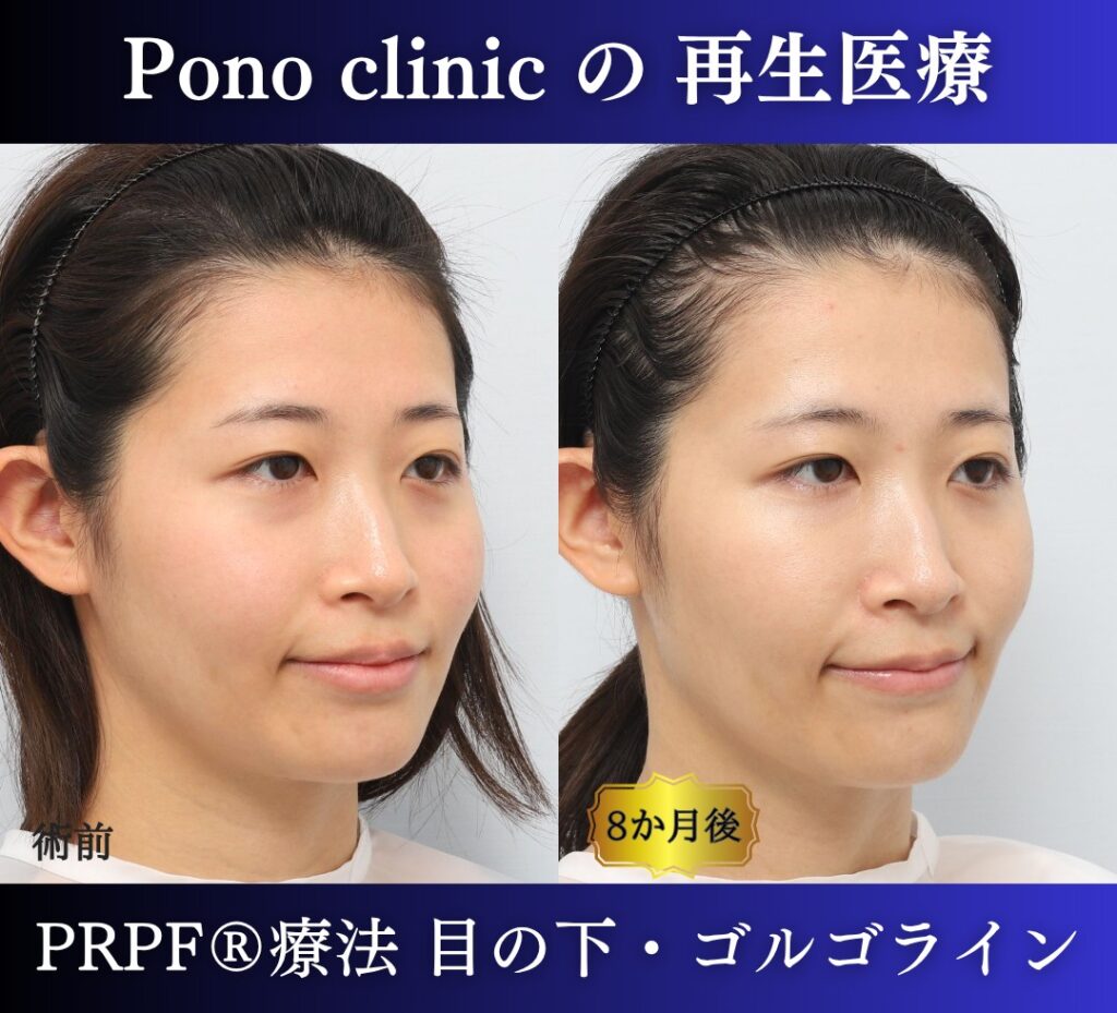 目の下のクマ、ゴルゴライン、クマ取り注射、PRPF療法 (9)