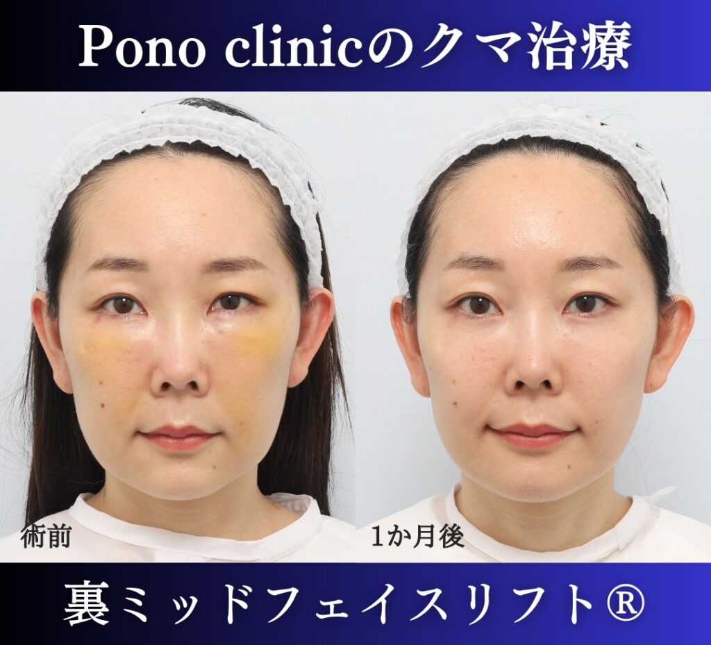 目の下のクマ取り、裏ハムラ、30代女性の症例 (1)