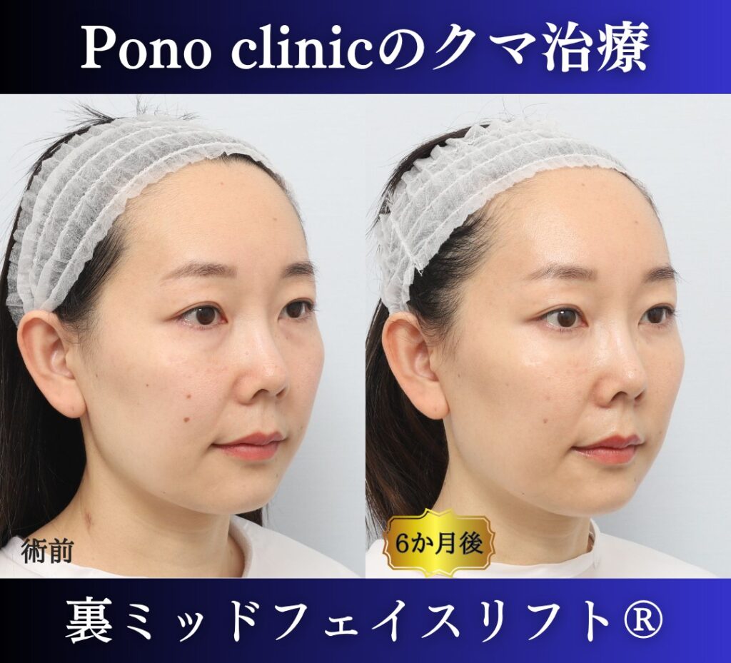 目の下のクマ取り、裏ハムラ、30代女性の症例 (2)