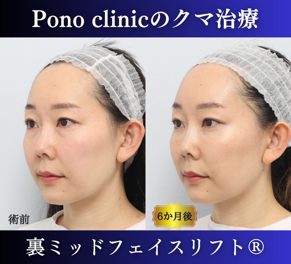 目の下のクマ取り、裏ハムラ、30代女性の症例 (3)