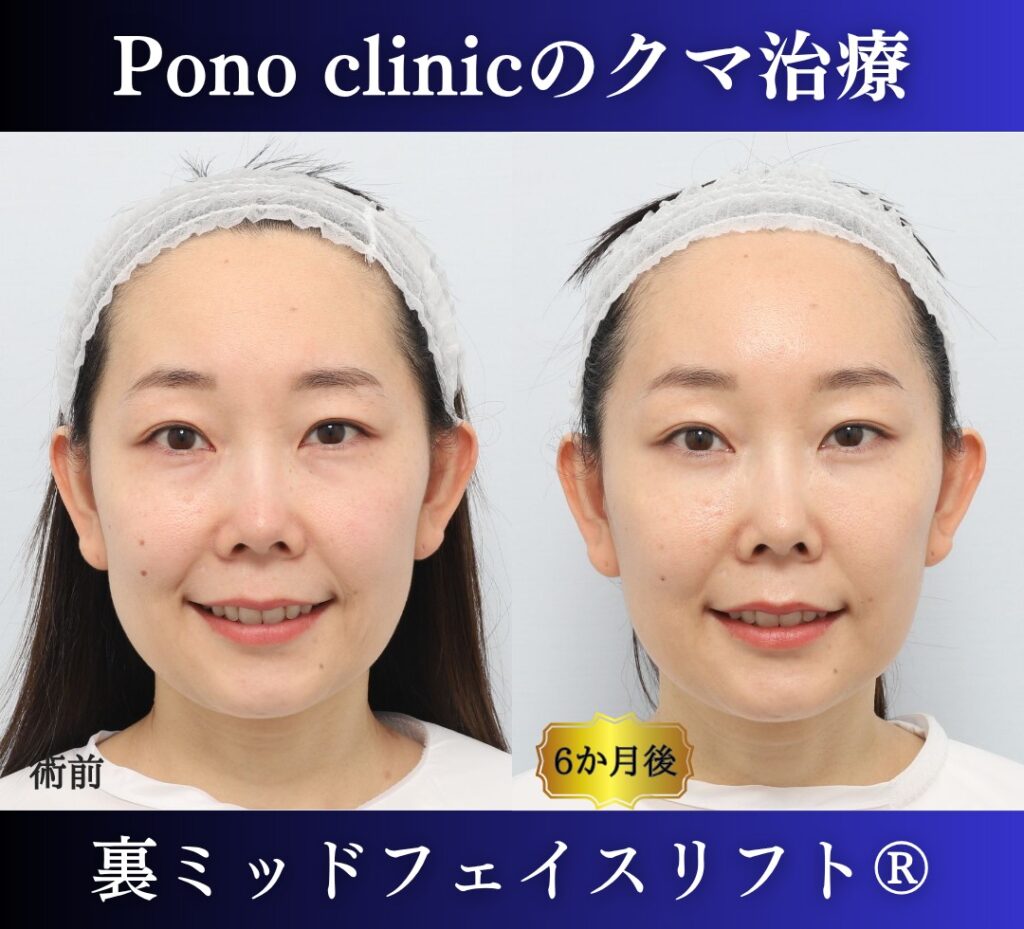 目の下のクマ取り、裏ハムラ、30代女性の症例 (4)