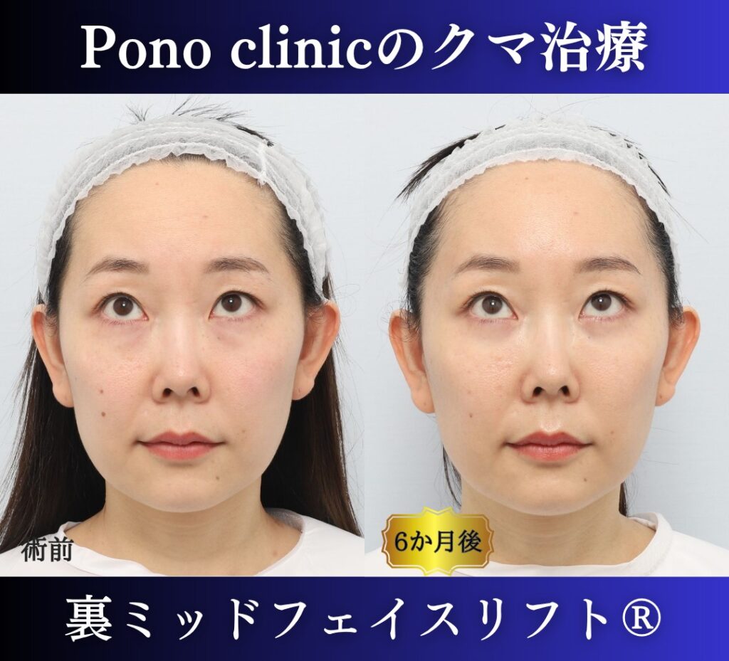 目の下のクマ取り、裏ハムラ、30代女性の症例 (5)