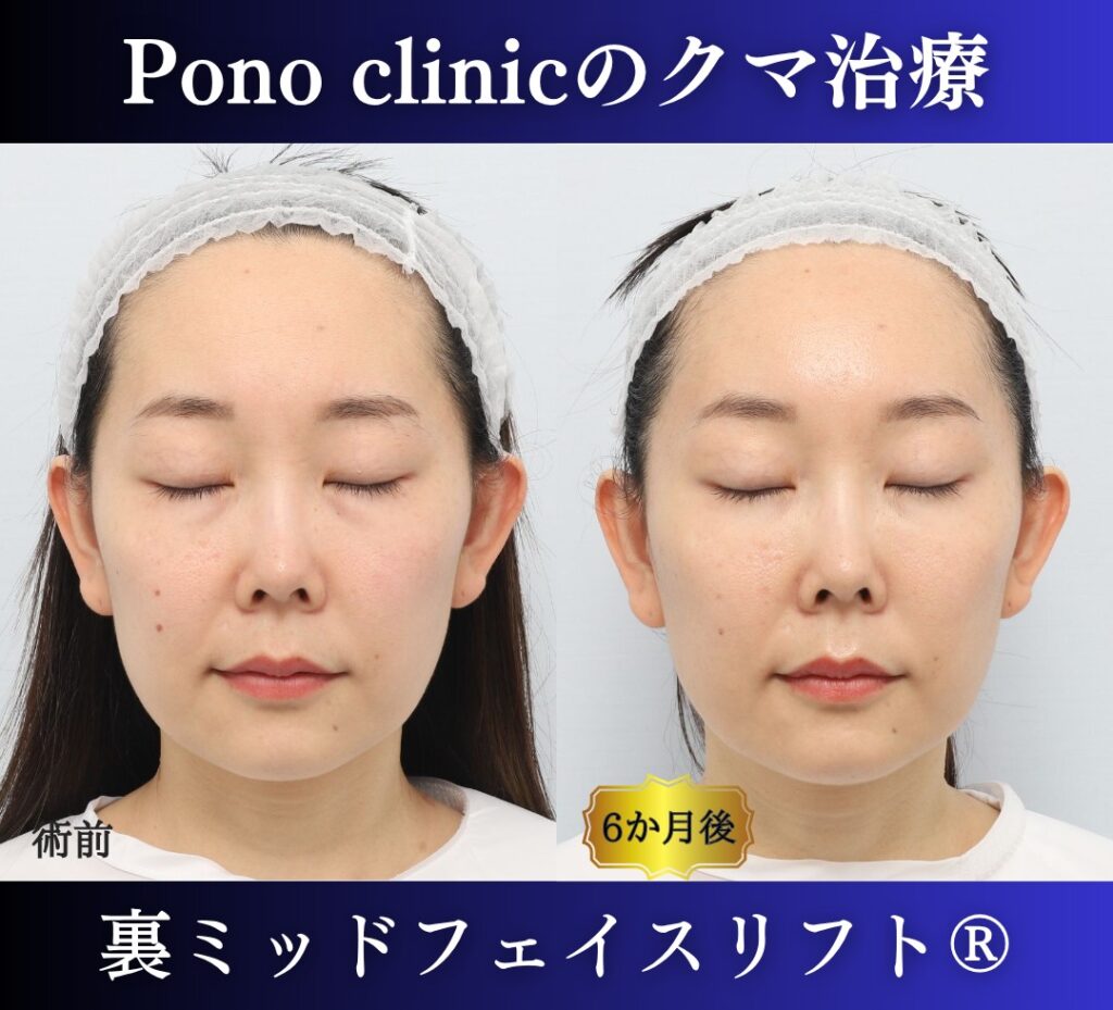 目の下のクマ取り、裏ハムラ、30代女性の症例 (6)