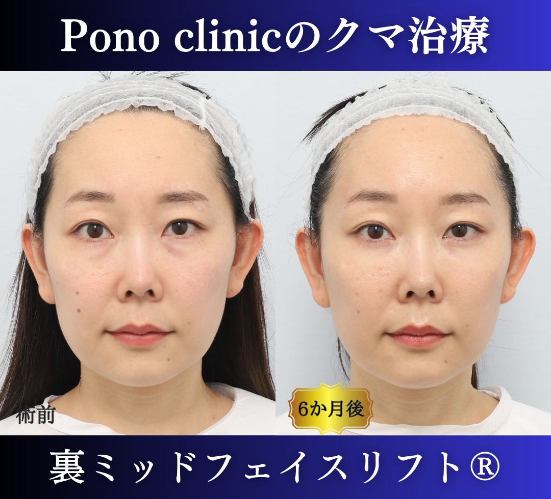 目の下のクマ取り、裏ハムラ、30代女性の症例 (7)