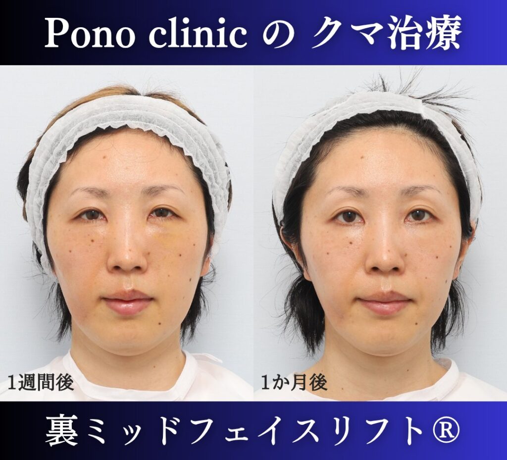 30代女性、目の下のクマ、裏ハムラ、ミッドフェイスリフト、クマ取り (1)