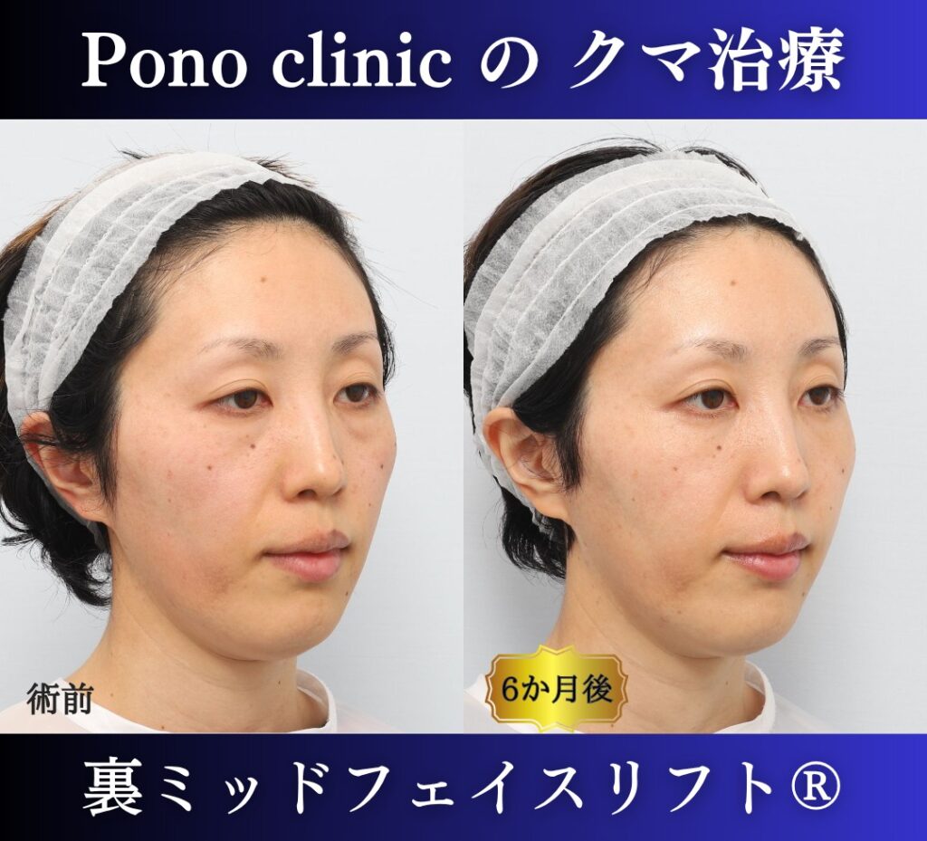 30代女性、目の下のクマ、裏ハムラ、ミッドフェイスリフト、クマ取り (2)