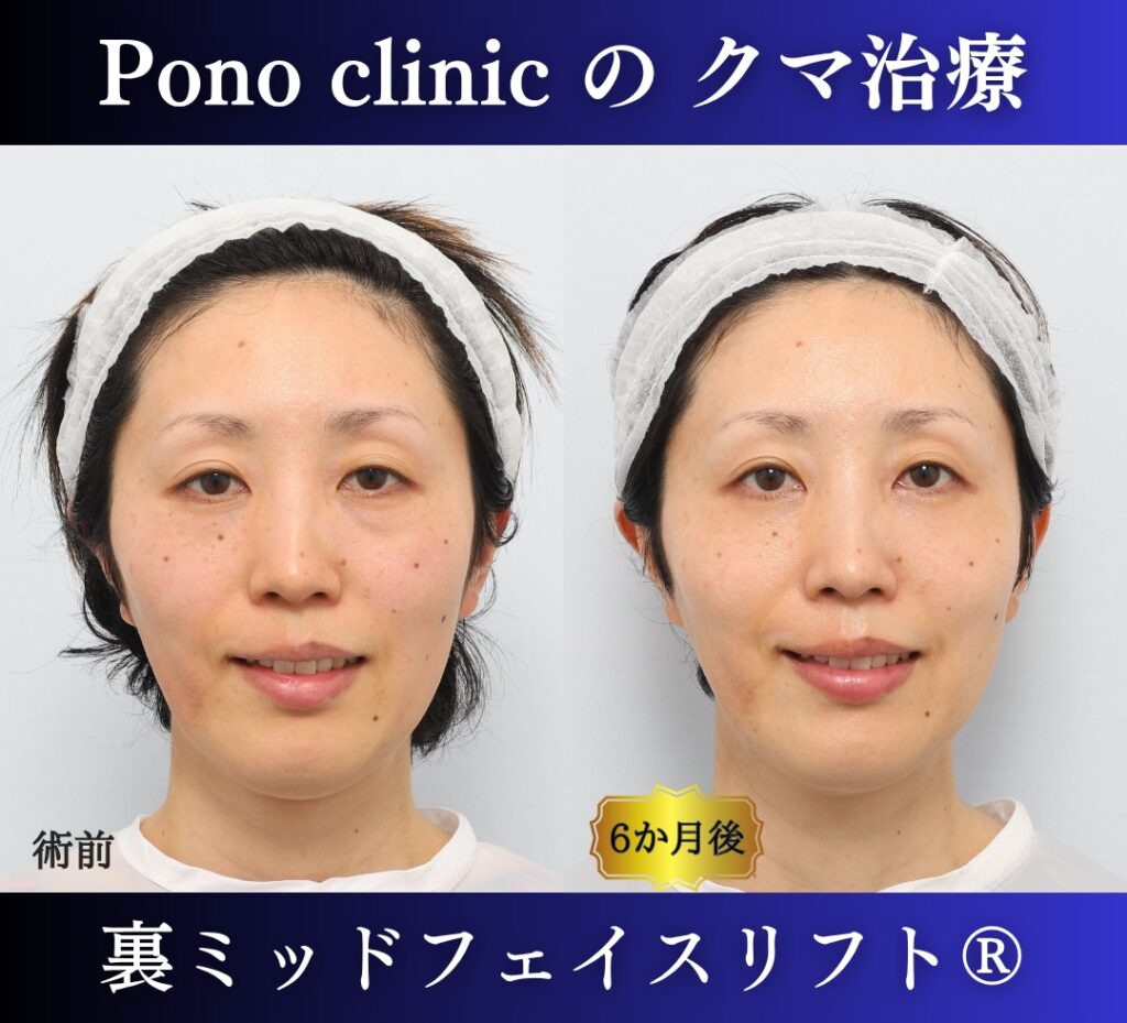 30代女性、目の下のクマ、裏ハムラ、ミッドフェイスリフト、クマ取り (4)