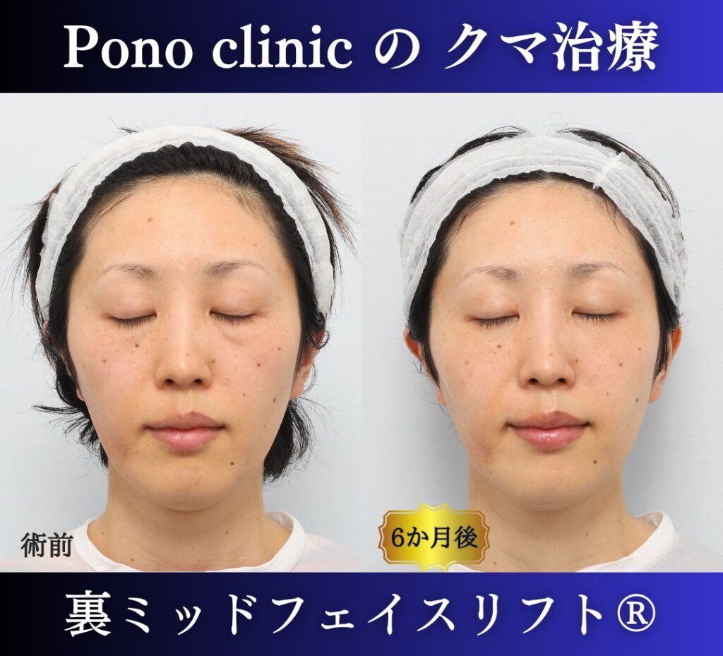 30代女性、目の下のクマ、裏ハムラ、ミッドフェイスリフト、クマ取り (6)