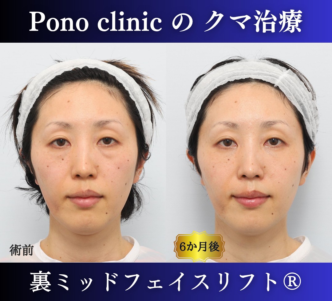 30代女性、目の下のクマ、裏ハムラ、ミッドフェイスリフト、クマ取り (7)