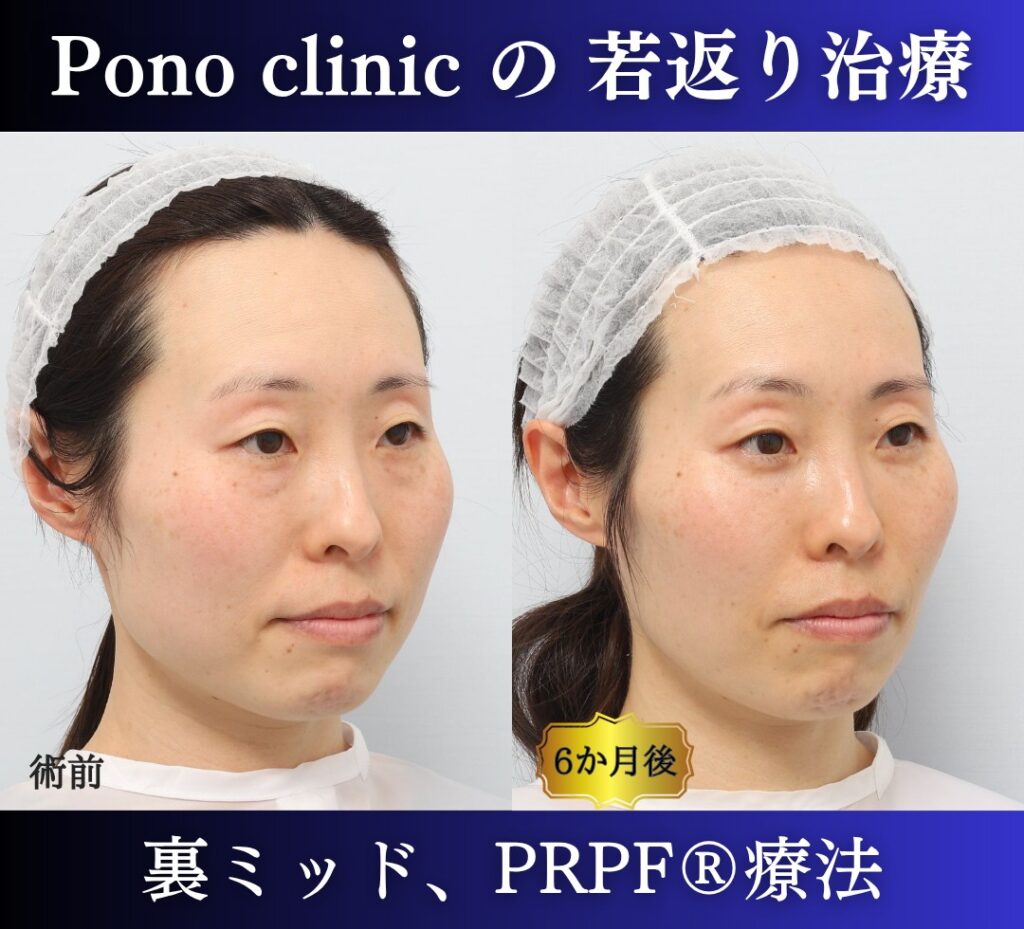 40代女性、目の下のクマ取り、裏ハムラ、ミッドフェイスリフト、法令線治療、しわ治療 (2)